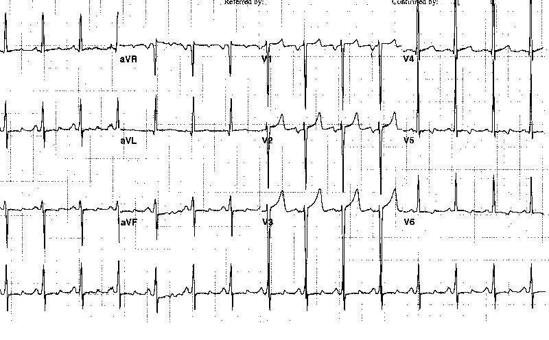 Kardiyak hipertansiyon durumunda EKG